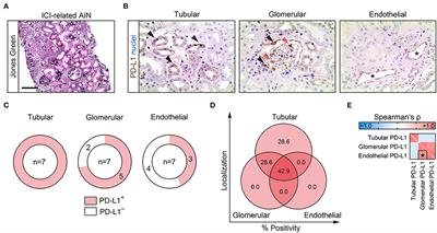 Compartmentalization of Intrarenal Programmed Cell Death Protein 1-Ligand 1 and Its Receptor in Kidney Injury Related to Immune Checkpoint Inhibitor Nephrotoxicity